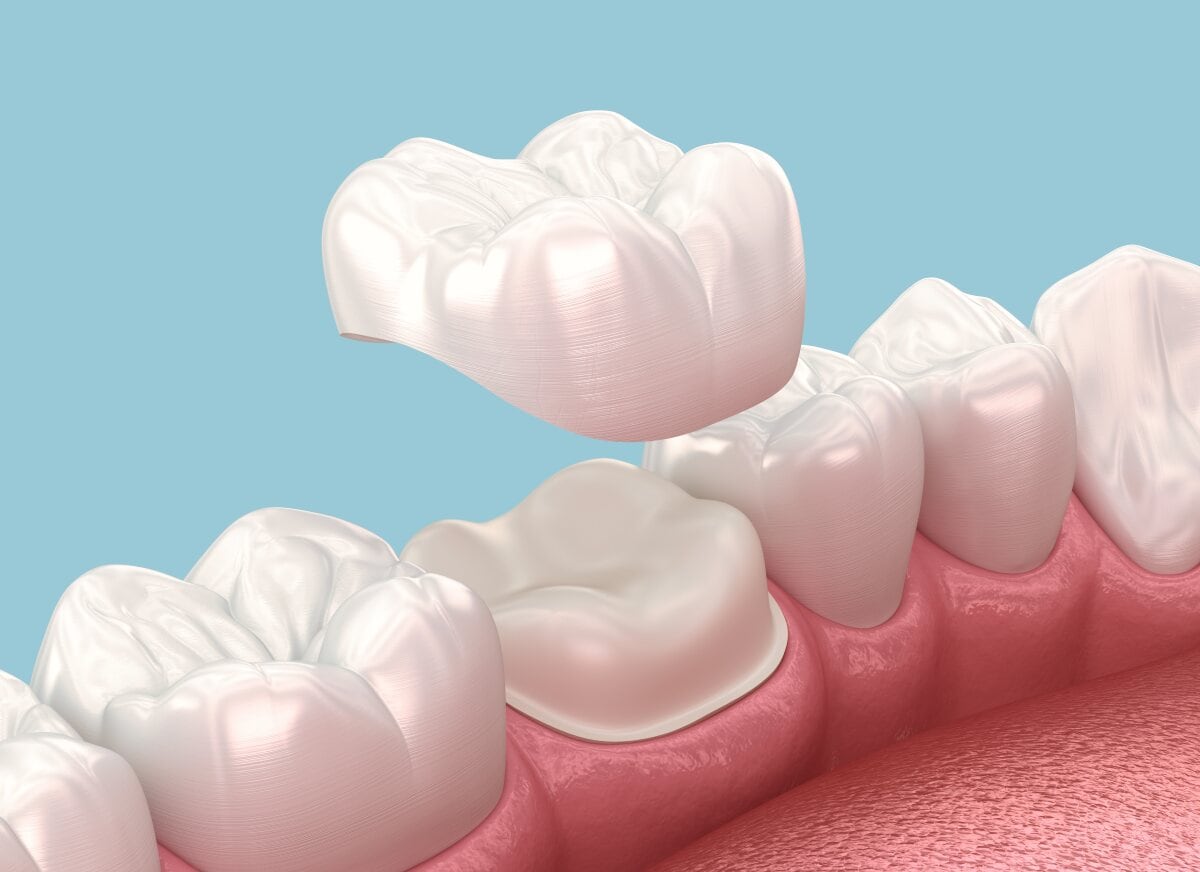 Dental crown Berlin Dental crown Berlin
