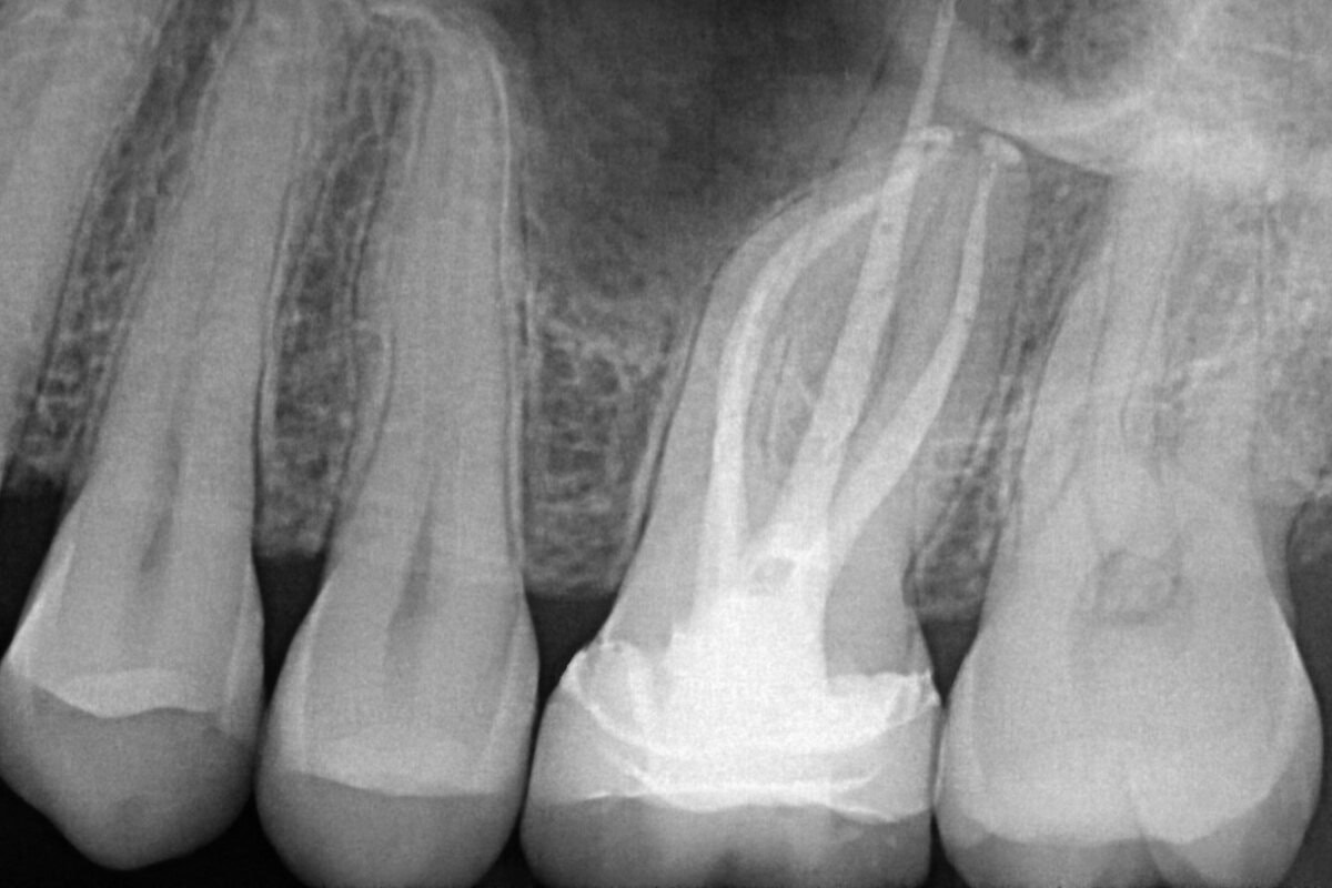 Root canal treatment X-ray Root canal treatment X-ray